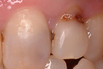 Dental caries