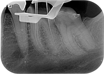 Pulpectomy_negotiation