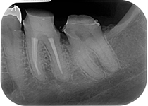 Pulpectomy_postop