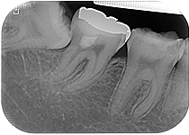 Vital Pulp Therapy 03_postop57m